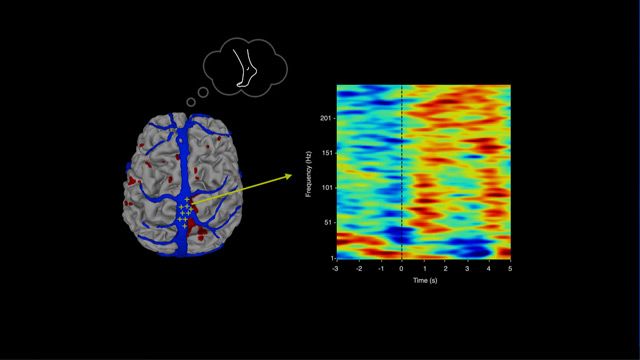 A Brain Implant That Turns Your Thoughts Into Text content piece image 