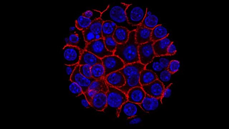 Blue and red fluorescence microscopy of pancreatic cancer cells.